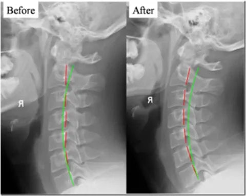 Appareil de Traction Cervicale avec Chaleur - Soulagement des Douleurs et Amélioration de la Posture